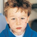 Molluscum contagiosum lapsilla
