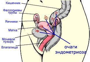 Endometrioosi: kansanhoito