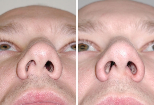 Miten käsitellään nenän septumin kaarevuus: leikkaus, laserkorjaus