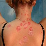 Kuinka hoitaa psoriaasi?