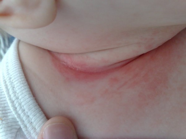 Onko aikuisen tai lapsen kaulassa ollut ihottumaa? Tärkeimmät hoitomenetelmät ja kohdunkaulan ihottuman ehkäisy