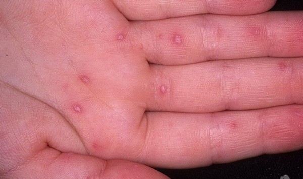 Ihottumat aikuisilla: valokuvat, ihottumien syyt ja ihon ihottuma